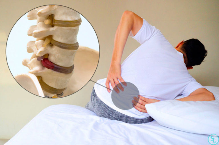 Як правильно вибрати матрац при грижі хребта